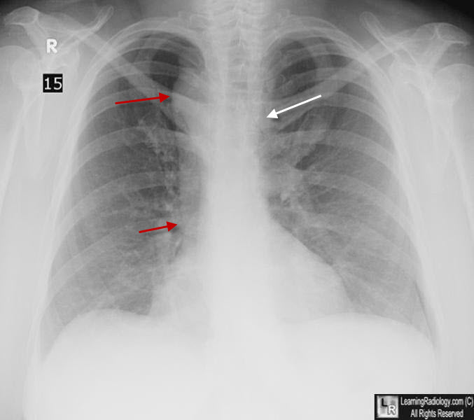 Right Aortic Arch